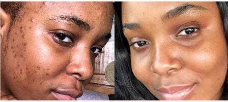 turmeric soap before and after turmeric soap before and after